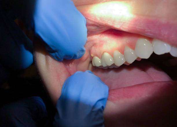 Best Emergency Tooth Extraction in Eatonton, GA