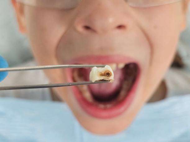 Best Emergency Tooth Extraction in Eatonton, GA